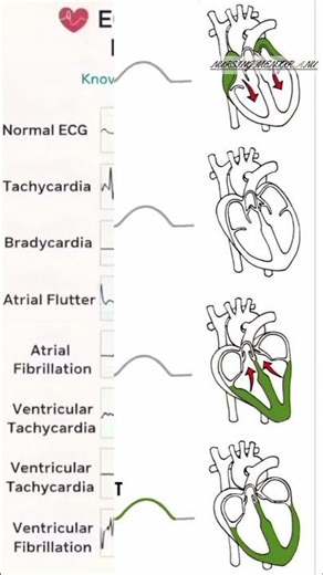 “ECG Rhythms Made Easy in 30 Second #ECG #NursingStudent #MedicalEducation #NurseLife