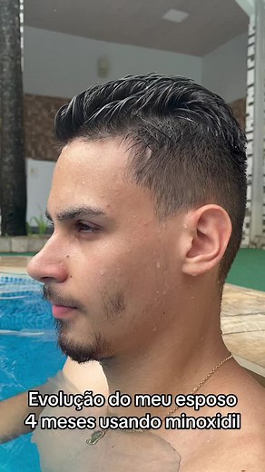 Evolução da Barba com Minoxidil em 4 Meses