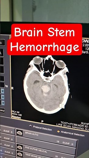 CT Brain stem hemorrhage