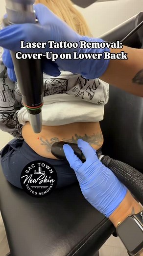 ⚡️Affordable Laser Tattoo Removal⚡️ Large, dense and very black...