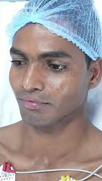 Cleft Lip Scar Revision Fuller Lips, Better Shape