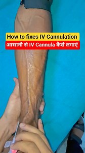 129K views · 748 reactions | IV Cannula kaise lagaye /how to fix IV cannulation#viralreelsシ #fbreelsfypシ゚ #fbreels #viralreelschallenge #trendingreelsvideo #trendingreel #fbshorts #viralvideochallenge #explorepage #trend #viralvideochallenge #viralreelsシ | Medical Info Tips | Facebook