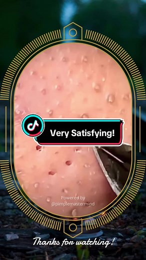 Satisfying Abscess Removal: Pimple Popping Skincare