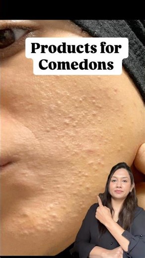 Comedonal Acne Treatment Routine | Benzoyl Peroxide + Salicylic Acid + Retinol |