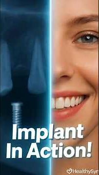 DENTAL IMPLANT SURGERY — Full 3D Animation Explained | Step-by-Step Procedure #shorts ‪@healthysync‬