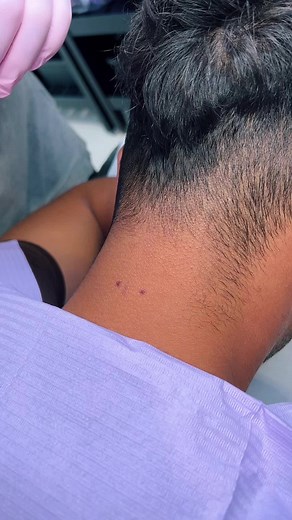 Nape piercing eseguito presso Pro-zac Body Piercing 💜 #silviaprozac #prozacbodypiercing #piercingbrescia #piercing #surfacepiercing #napepiercing #nape