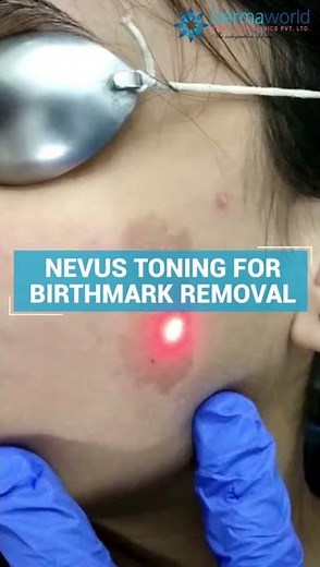 Nevus Toning for Birthmark Removal | Easy Birthmark Removal | Dermaworld