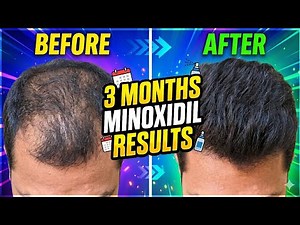 90 Days Minoxidil Result | Real Hair Regrowth Journey (Before vs After) | Hair Regrowth with Anant
