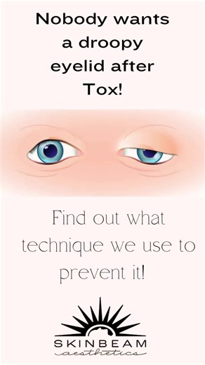 Don’t worry about getting a eyelid ptosis during your Botox injections here at Skinbeam! This is the injection technique we use to prevent it! 💛 Has this ever happened to you during a Tox appointment?! Is there any side effects from Tox or other injectables/treatment that make you nervous to get them? Let’s talk about it in the comments!! ⬇️ Here’s the article I am referencing in the video, in case anyone is interested! 🧑🏼‍🔬 Cotofana S, Pedraza AP, Kaufman J, Avelar LET, Gavril DL, Hernandez