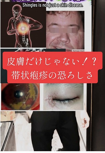 帯状疱疹の恐ろしい後遺症とは