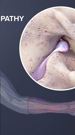 Cervical Radiculopathy ⚠️ Don’t Ignore Sudden Arm or Leg Weakness!
