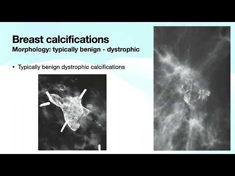 Breast Calcifications Part 1 | Free Radiology CME