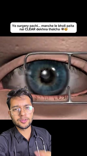 Chasma lagayera hairan bhako manche haru… yo surgery literally life changing huna sakcha 👀⚡ Tara LASIK magic hoina — science ho. Ra sabai jana yo surgery ko perfect candidate hudainan. 👁️ #LASIK #EyeSurgery #MedicalFacts #VisionCorrection #NepaliContent