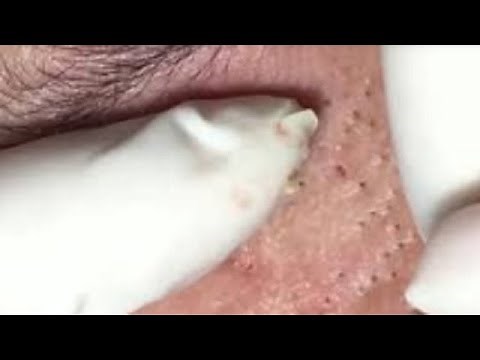 How to Pop a Pimple, Pimple Popping, Acne Blackheads Removal