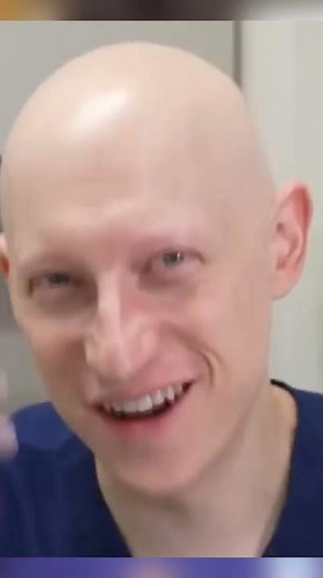 What is Alopecia Universalis? Alopecia Universalis and It's effects! Third Stage of Alopecia Areata!