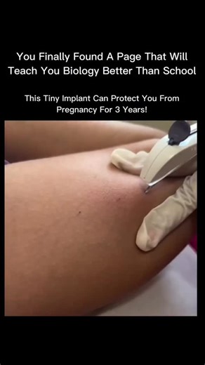 HEALTH | EDUCATION | This tiny implant can protect you from pregnancy for up to 3 YEARS! 🤯✨ The contraceptive implant is a small, matchstick-sized rod placed... | Instagram