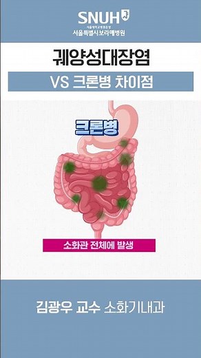 Differences between Ulcerative Colitis and Crohn's Disease