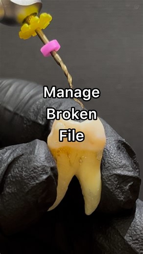 Dentistry hands on on Instagram: "✅ With reciprocating motion, you can open the path much easier! What is the reciprocating motion? A back-and-forth movement of files is called reciprocating motion. The rotation in cutting direction is larger than the reverse rotation. ✅ Remember the key to success in endo treatment is effective irrigation of the full length of the canal. . . . #dental #dentalstudent #dentalstudents #dentalschool #dentistry #dentistrystudent #dentistrystudents #odonto #odontolog