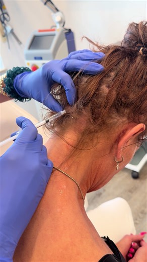 💆‍♀️ Nacken ständig verspannt? 📱 Handy • 💻 Büro • 😣 Stress? 👉 Botox gegen Verspannungen im Nackenbereich entspannt gezielt überaktive Muskeln 💉✨ ✔️ weniger Spannung ✔️ mehr Beweglichkeit ✔️ spürbare Entlastung im Alltag ⏱️ Schnell & effektiv – ideal für deinen Alltag 🙌 💰 Investition: 350 € 📍 SN-Dermaline, Alfeld 👩‍⚕️ Saliha Jasarov & Dr. Vural 📞 0172 9667002 | 05181 8495127 🌐 www.sn-dermaline.de ✨ Schreib uns & fühl dich wieder locker! #botox #fy #viral #viralvideos #fypageシ