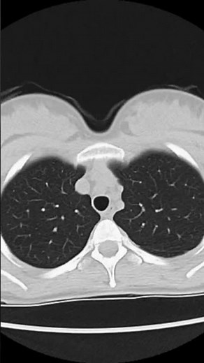 Normal Chest CT of Lungs