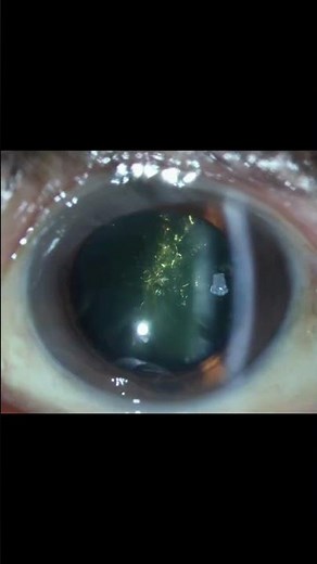christmas tree cataract #medical #anatomy #neet #fmge #opthalmology