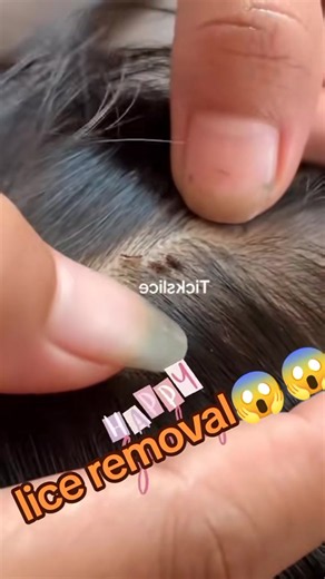 How to Get Rid of Lice Fast: Effective Home Treatments