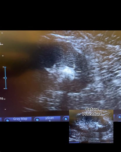Another successful kidney stone treatment with shockwave lithotripsy. A safe, effective, and non-invasive option for urinary stones. (Note: This treatment is for urinary stones, not gallstones.) | Kidney Stone and Shockwave Urology Manila