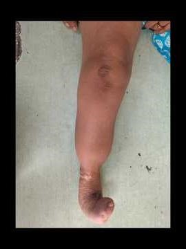 Life Changing Moment:First Steps with a Prosthesis (Congenital limb Deficiency)