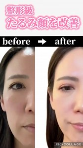 さち｜ 40代からの「10歳若返り」美容法 | リンパ流し整形級小顔になる✨ ⁡ 筋膜が癒着くして、引っ張っられて たるみ、浮腫み、老け顔に ⁡ ポスポスさん 2分やるだけで 本当に変わる✨ フェイスポインター @corefit_bbyc COREFIT公式オンラインストアから ご購入すると割引⬇︎できます⬇︎... | Instagram