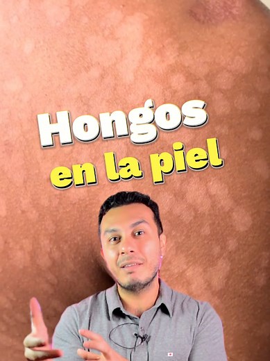 Pitiriasis Versicolor: Síntomas y Tratamientos Efectivos