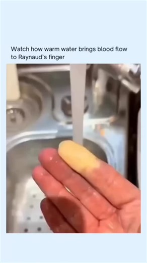 ScienceX on Instagram: "Raynaud’s phenomenon occurs when the small blood vessels in the fingers temporarily narrow, most commonly in response to cold temperatures or emotional stress ❄️🖐️. When these vessels constrict, blood flow is reduced, causing the fingers to turn white or blue and feel numb, tingly, or even painful. This reaction happens because the body prioritizes protecting vital organs, briefly limiting circulation to the extremities. While it’s a protective reflex, it can be uncomfor