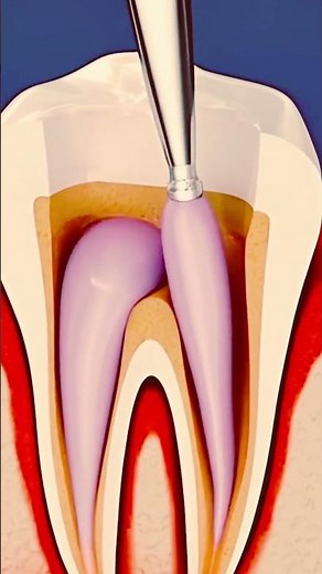 Inside a Root Canal 🦷 | How Dentists Save Your Tooth!