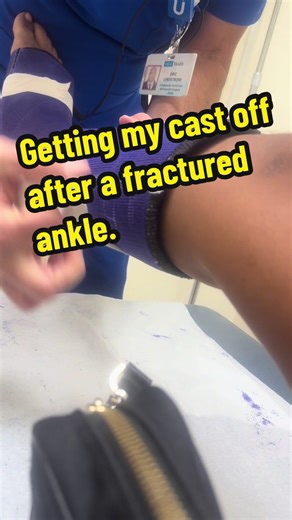 Getting My Cast Off After Ankle Fracture