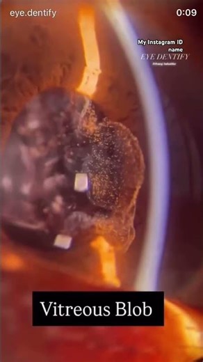 A vitreous bulge (or prolapse) #medico#eyedoc#optomed#visionresearch#retinanet# #neet