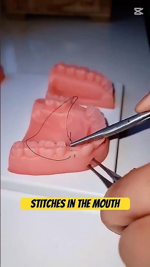 “Dental Stitches—Quick Guide!”