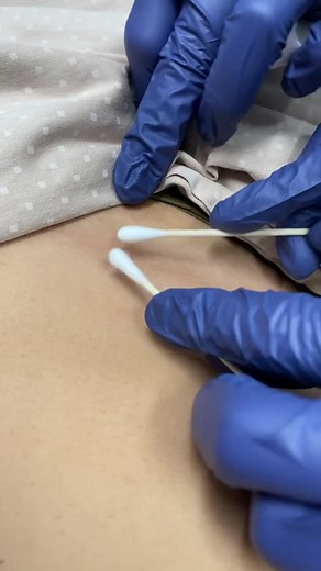 Eruptive vellus hair cyst removal #cyst