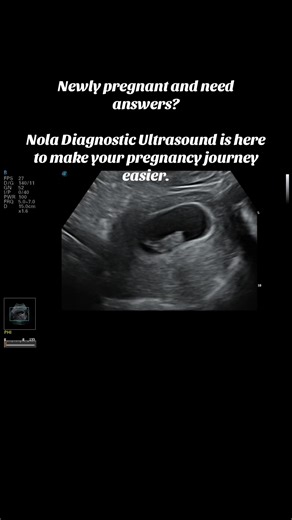 At your ultrasound, we will establish your baby's due date and provide all the answers you need, so your provider can review them with you. Ask your provider to fax your order to 337 761 1682 or email it to hello@neworleansultrasound.com and book online at nolaultrasound.com #diagnosticultrasound #OBultrasound #neworleansultrasound