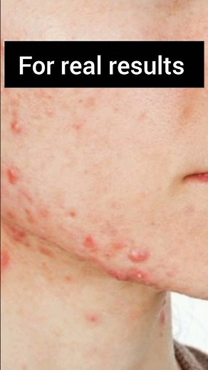 Does Drinking Water Clear Acne? Here’s What Actually Works! 💧🧴