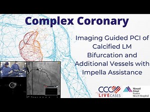 Imaging Guided PCI of Calcified LM Bifurcation and Additional Vessels with Impella Assistance
