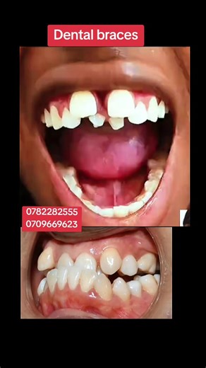 #Teeth alignment with braces#for better smiles #kampala_uganda🇺🇬🇺🇬🤝 #creatorsearchinsights