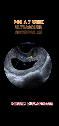 Missed Miscarriage at 7 Weeks: Understanding the Signs
