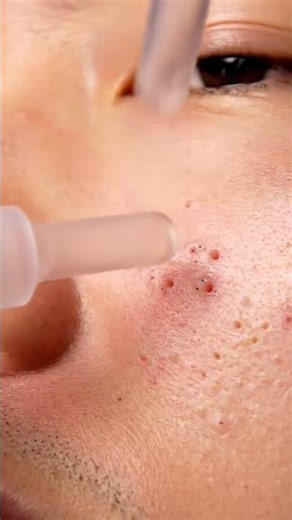 Deep Nose Blackhead Extraction ASMR