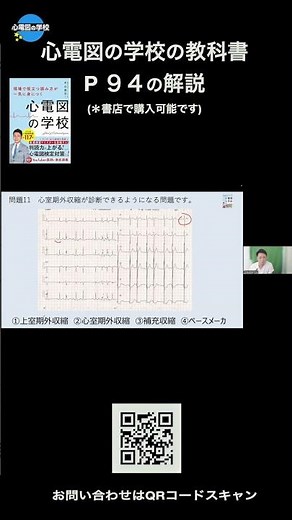 Supraventricular premature contractions? Ventricular premature contractions?