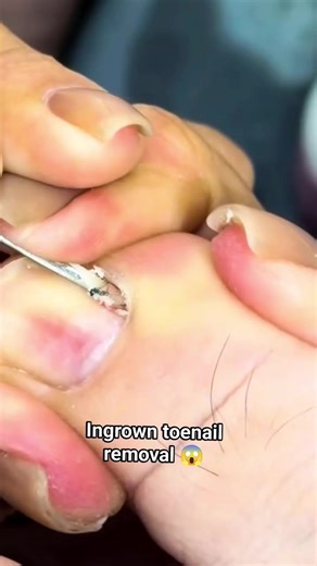 Effective Ingrown Toenail Removal Techniques