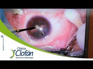 Terapia antiangiogénica para tratar la degeneración macular - Clínica Clofán