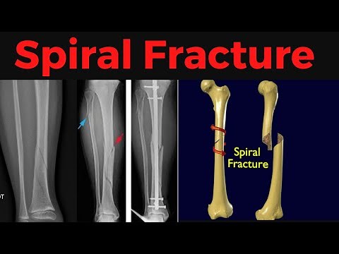 What is Spiral Fracture? Spiral Fracture Symptoms, Causes, Treatment, X-ray