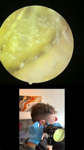 Young patient hears again #earwaxremoval #microsuction #satisfyingvideo #earcleaning #asmr #earwax