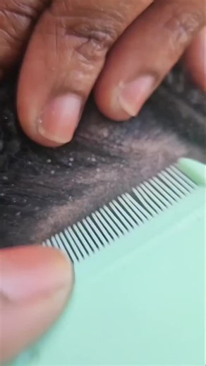 Itchy Scalp Relief: Satisfying ASMR Cornrow Sounds