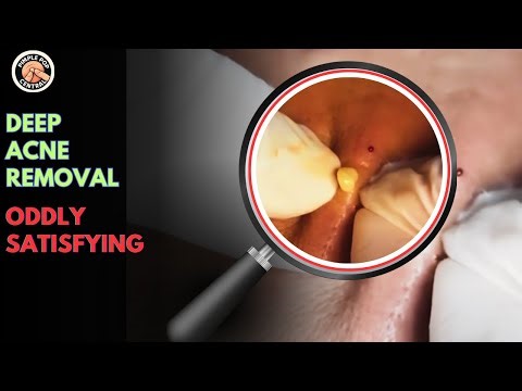 Deep Acne Removal & Oddly Satisfying – Deep Pimple Popping Compilation You Can’t Miss!