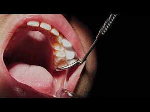 Fissure Sealant Procedure